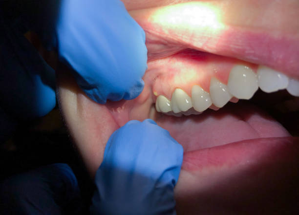 Best Broken or Cracked Tooth Emergency Dentist in Weirton, WV